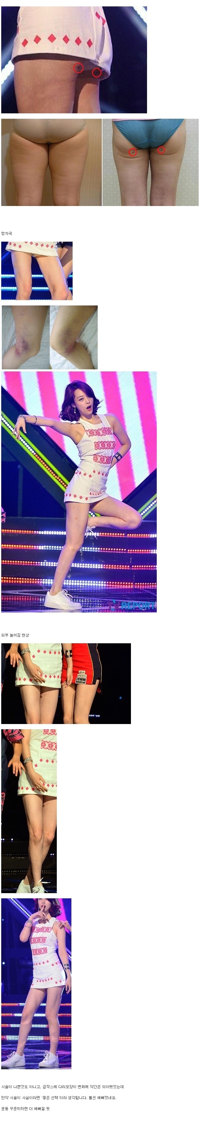 f(x) 설리 지방흡입 시술 자국 | 인스티즈