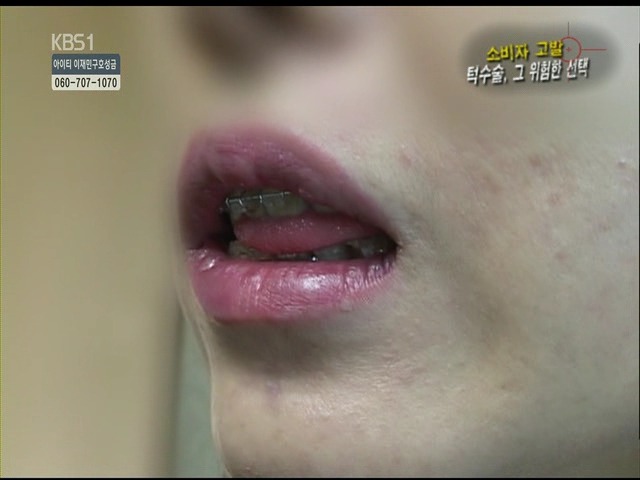 언니들!! 양악수술!!! 제대로 알아보고하자!!! | 인스티즈