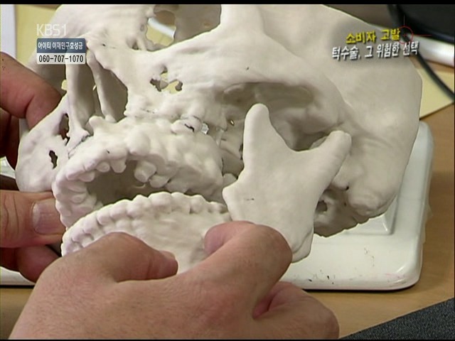 언니들!! 양악수술!!! 제대로 알아보고하자!!! | 인스티즈