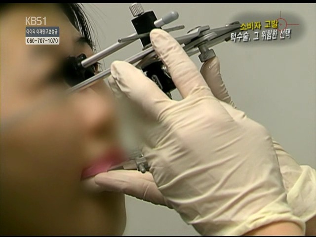 언니들!! 양악수술!!! 제대로 알아보고하자!!! | 인스티즈