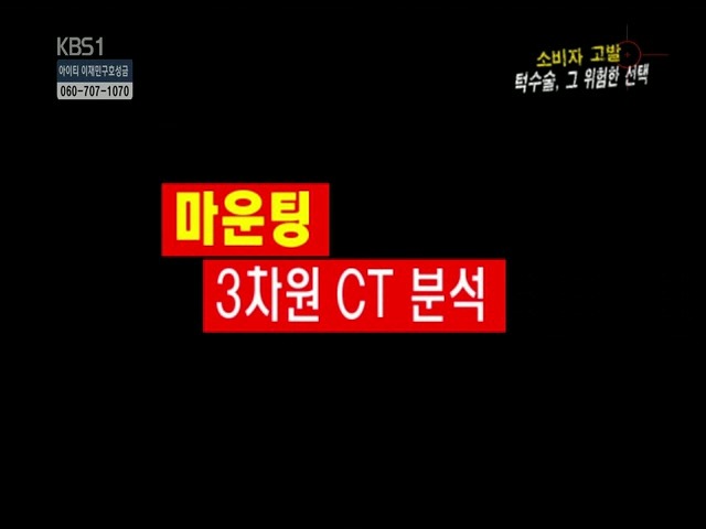 언니들!! 양악수술!!! 제대로 알아보고하자!!! | 인스티즈