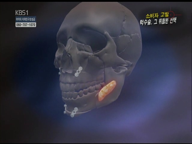 언니들!! 양악수술!!! 제대로 알아보고하자!!! | 인스티즈