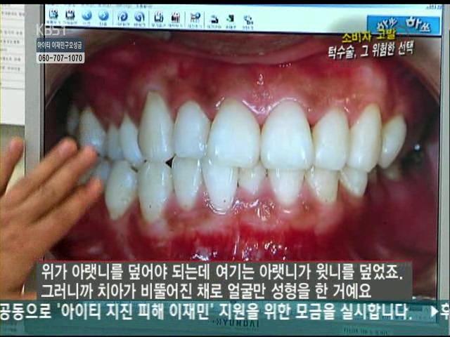 언니들!! 양악수술!!! 제대로 알아보고하자!!! | 인스티즈