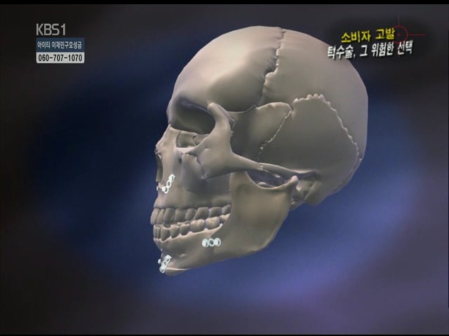 언니들!! 양악수술!!! 제대로 알아보고하자!!! | 인스티즈