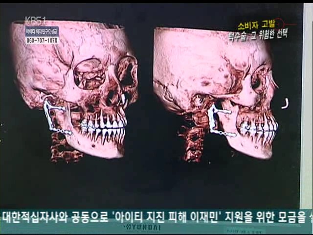 언니들!! 양악수술!!! 제대로 알아보고하자!!! | 인스티즈