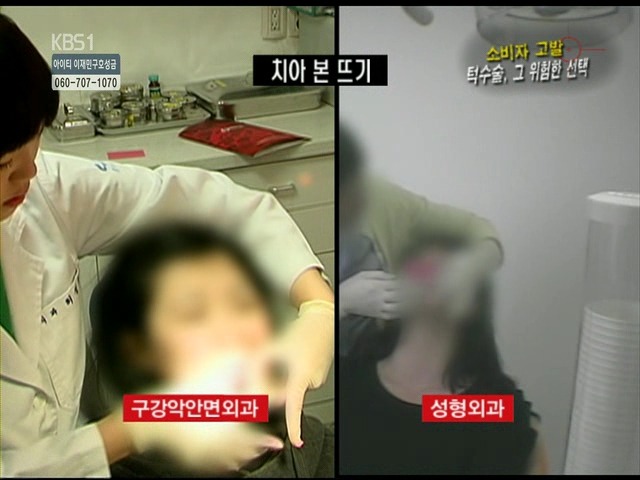 언니들!! 양악수술!!! 제대로 알아보고하자!!! | 인스티즈