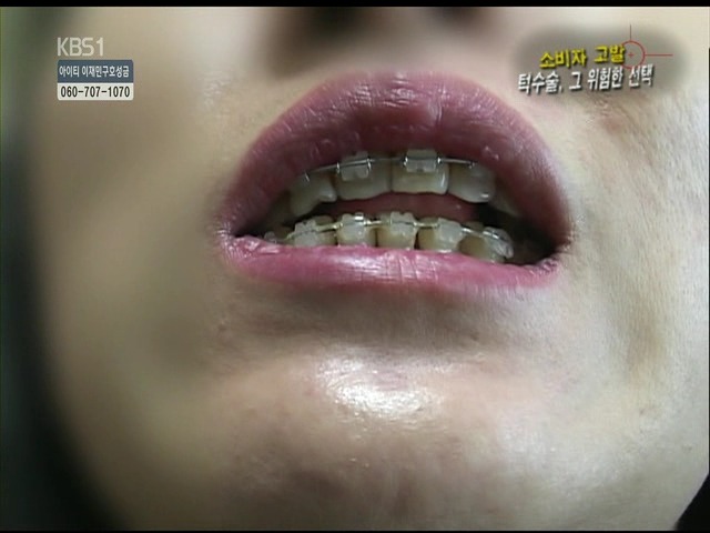 언니들!! 양악수술!!! 제대로 알아보고하자!!! | 인스티즈