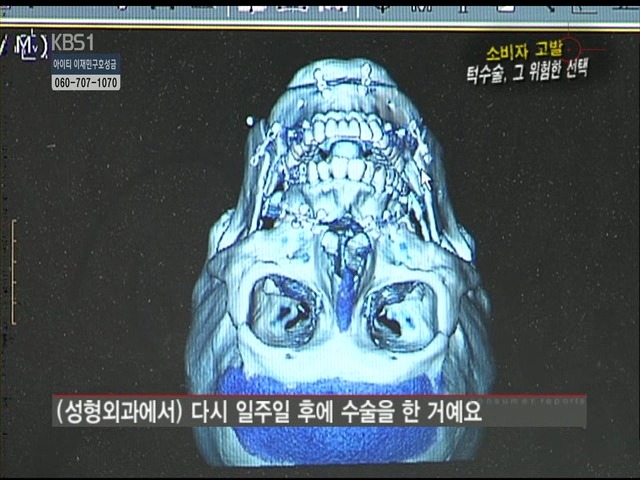 언니들!! 양악수술!!! 제대로 알아보고하자!!! | 인스티즈