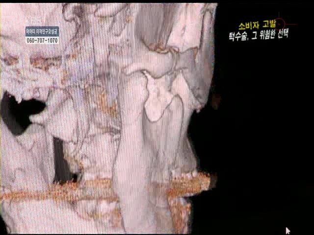 언니들!! 양악수술!!! 제대로 알아보고하자!!! | 인스티즈