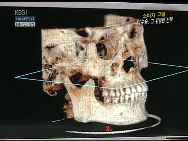 언니들!! 양악수술!!! 제대로 알아보고하자!!! | 인스티즈