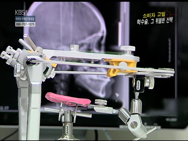 언니들!! 양악수술!!! 제대로 알아보고하자!!! | 인스티즈