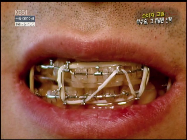 언니들!! 양악수술!!! 제대로 알아보고하자!!! | 인스티즈