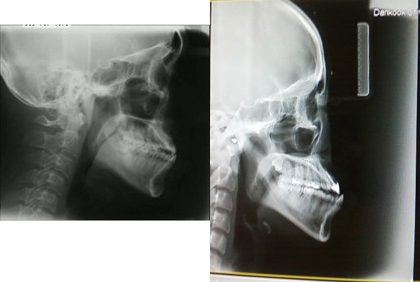 언니들!! 양악수술!!! 제대로 알아보고하자!!! | 인스티즈