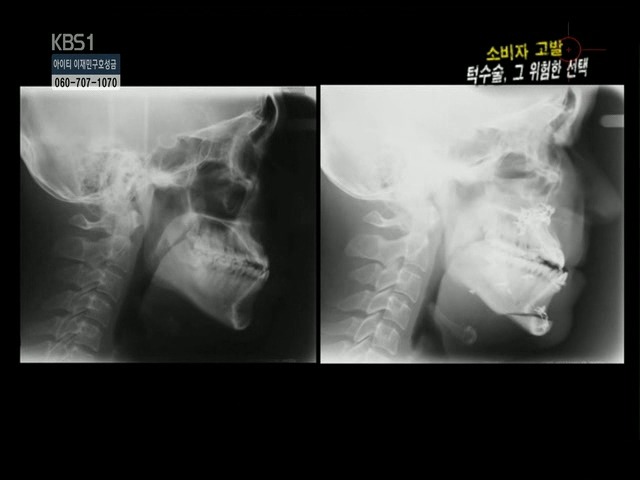 언니들!! 양악수술!!! 제대로 알아보고하자!!! | 인스티즈