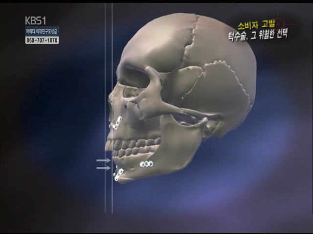 언니들!! 양악수술!!! 제대로 알아보고하자!!! | 인스티즈