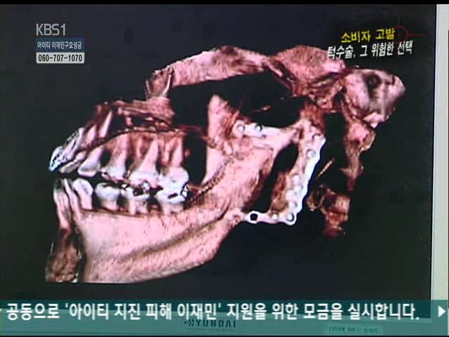 언니들!! 양악수술!!! 제대로 알아보고하자!!! | 인스티즈