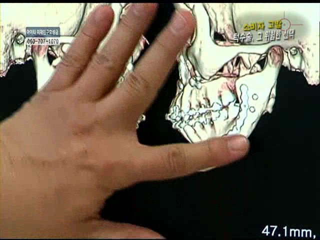 언니들!! 양악수술!!! 제대로 알아보고하자!!! | 인스티즈