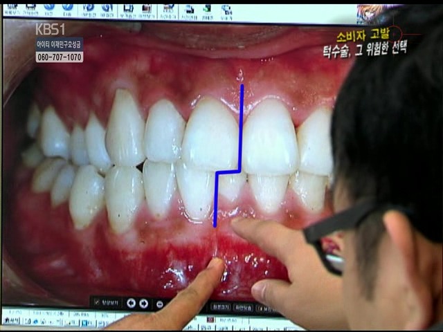 언니들!! 양악수술!!! 제대로 알아보고하자!!! | 인스티즈