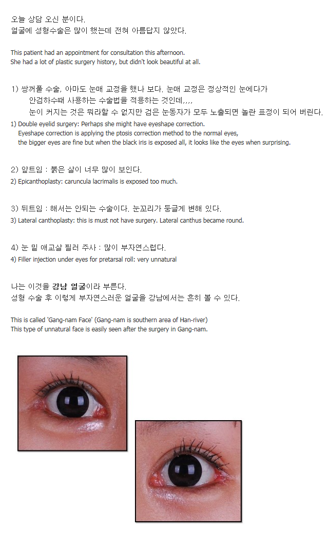 성형외과 의사가 쓴 칼럼이오. 강남얼굴/ 하지 말아야 할 8가지 수술/ 성형수술 후 부작용 | 인스티즈