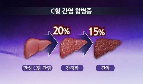 국내 간암환자 대부분은 술과 큰 상관이 없다 | 인스티즈